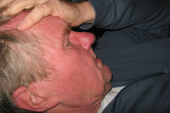 hjerneblødning efter fald hjerneblødning efter fald